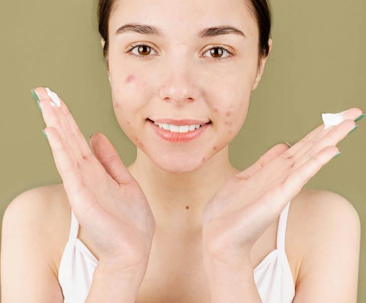 7 Effective Ways to Target Acne Scarring